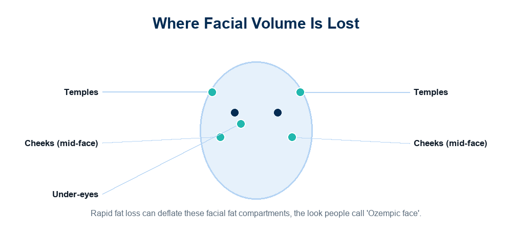 Diagram of the facial fat compartments (temples, cheeks, under-eyes) that deflate, the look called Ozempic face